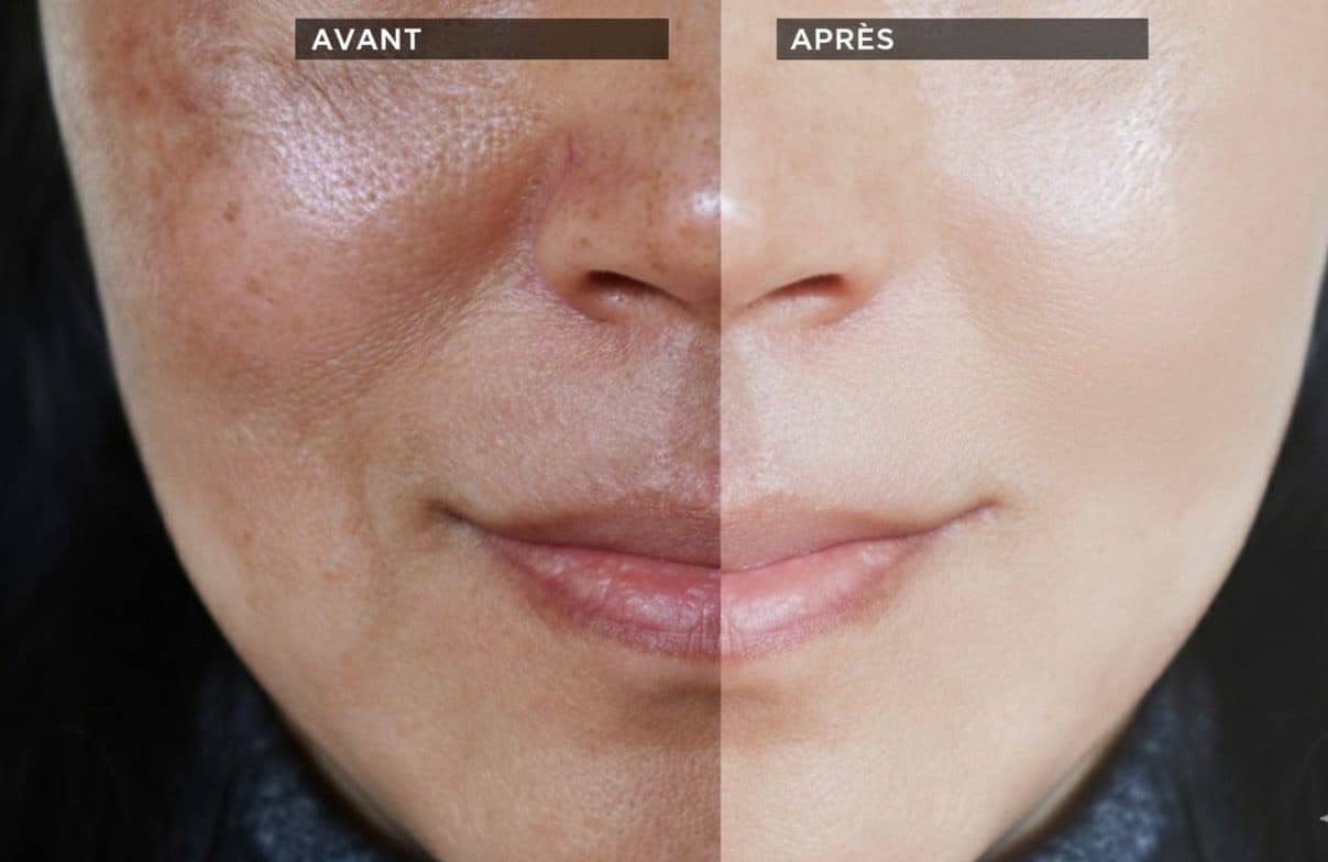 dermopigmentation cicatricielle avant-apres C3 Paris